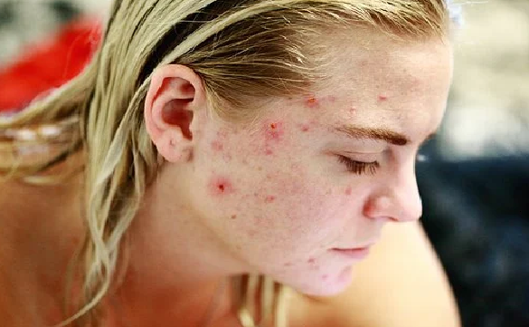Pimple treatment